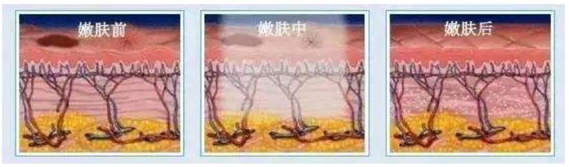 只做一次光子嫩肤的果能维持多久？