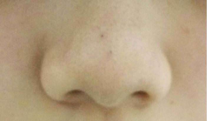 有黑头应该怎么办？有的处理方法！
