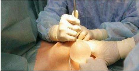 假体隆胸手术中采用哪种手术切口会比较好?