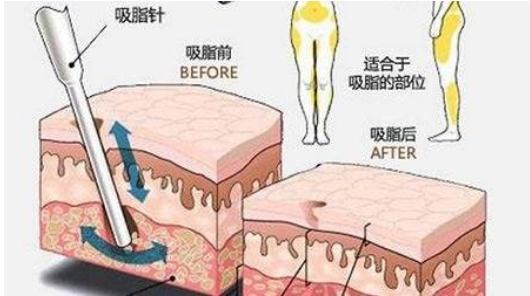 抽脂减肥价格和吸脂量以及手术方法有关