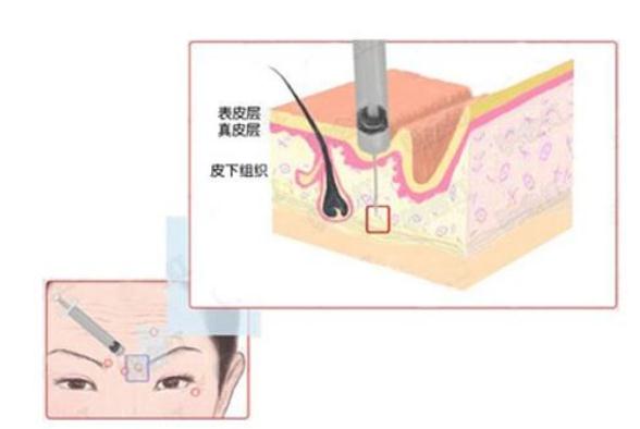 玻尿酸和的本质区别是什么？