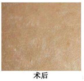 激光妊娠纹修复手术的价位！
