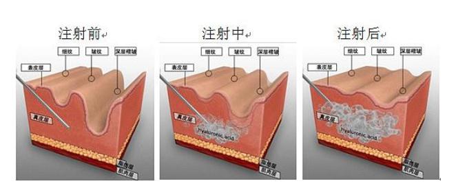 注射玻尿酸的功是什么？有副作用吗？