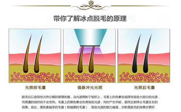 正规医院做冰点脱毛的价位是多少？