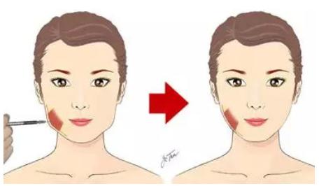 注射瘦脸的果能够维持多长时间?