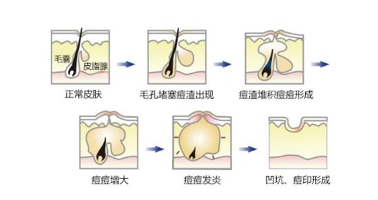 脸上青春痘留下的痘印可以去除吗？怎么去除？