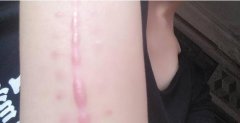 做完手术后，出现了疤痕增生怎么办？