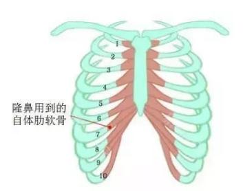 做完自体肋骨隆鼻术后多长时间可以恢复？