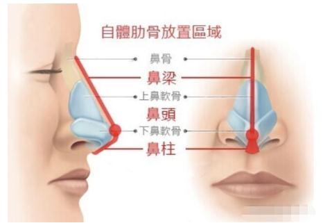 做完自体肋骨隆鼻术后多长时间可以恢复？