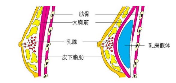 做假体隆胸手术大概得要多少钱？