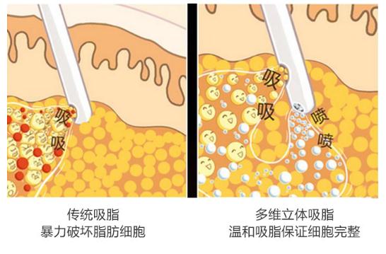 一般做腿部抽脂手术需要多少钱？