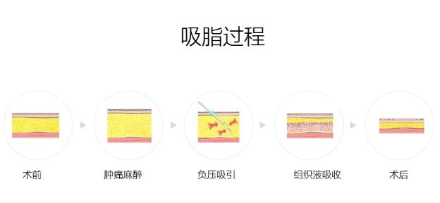 一般做腿部抽脂手术需要多少钱？