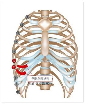 肋软骨隆鼻的优点