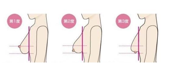哺乳后胸部下垂现象应该怎么办？如何改良？