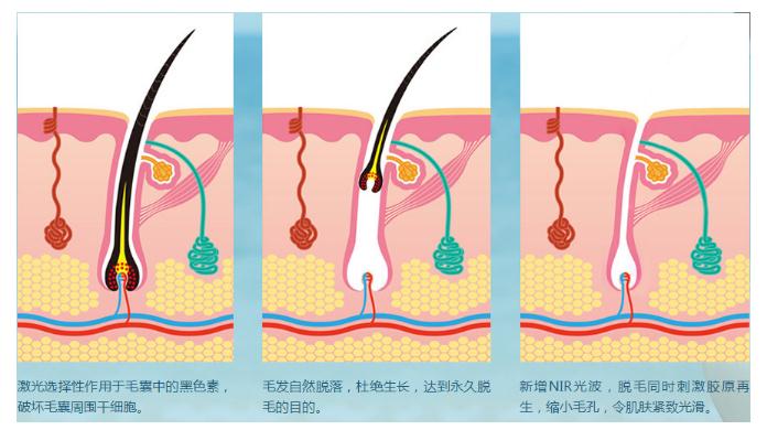 在整形美容机构做腋毛去除项目的果怎么样？