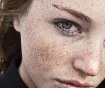 什么原因导致了面部黄褐斑产生？如何有的去除？
