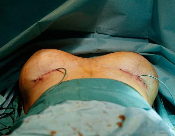 隆胸手术的假体可以终生不换取吗？