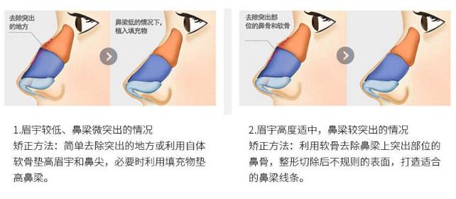 尽管驼峰鼻矫正不是什么大手术，但是还是得说