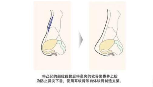 尽管驼峰鼻矫正不是什么大手术，但是还是得说