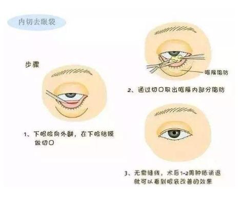 内切祛眼袋手术的果和价格，看这里~