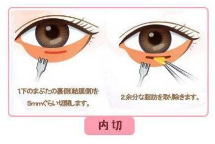 内切祛眼袋手术的果和价格，看这里~