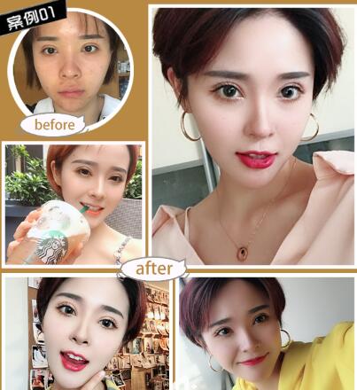 全切双眼皮术后3个月可以做修复手术了吗？