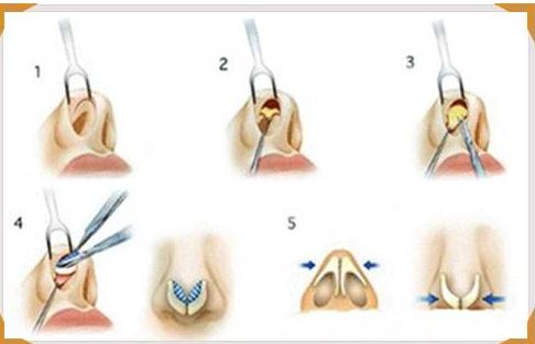 韩国艾恩整形医院专家告诉你，男女做隆鼻假体该如何选择！