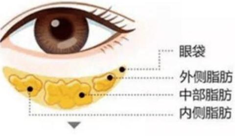 激光祛眼袋的副作用，手术之前有必要看一下！