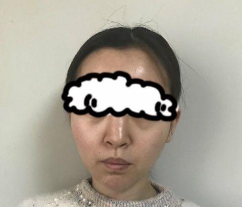 北京假体隆鼻修复介绍，术后分享！