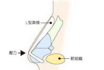 硅胶隆鼻能维持多久？可以保持一辈子吗？