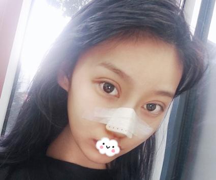整形初体验：假体隆鼻后整理的隆鼻经验分享