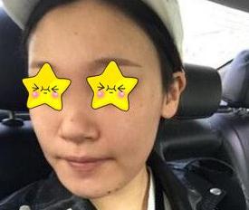 大老远跑去找季滢医生做了鼻子，隆鼻果分享