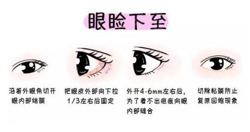 眼睑下至恢复期多久变自然？恢复较快小妙招！