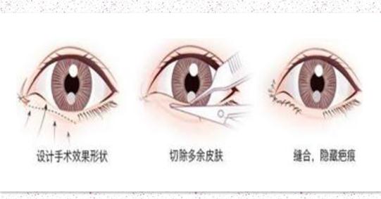 眼睑下至恢复期多久变自然？恢复较快小妙招！