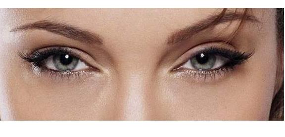 欧式双眼皮手术恢复期时间有多长？