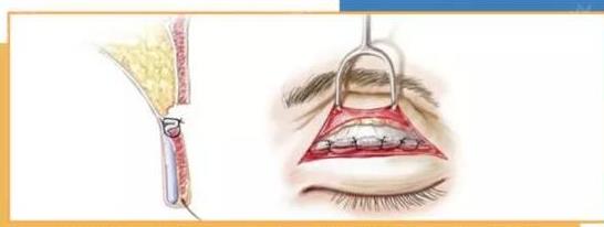 欧式双眼皮手术恢复期时间有多长？