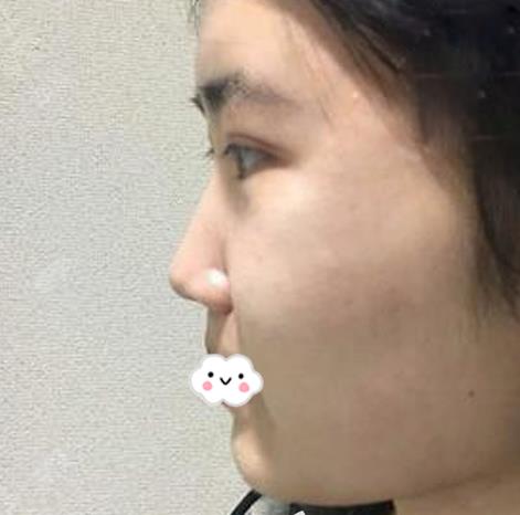 花了3w块钱的青岛伊美尔隆鼻介绍