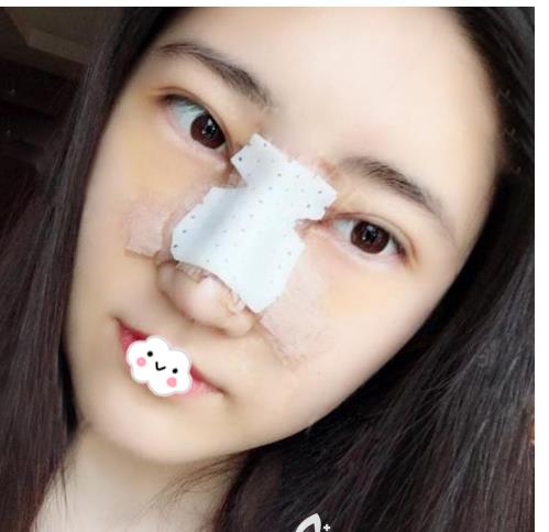 花了3w块钱的青岛伊美尔隆鼻介绍