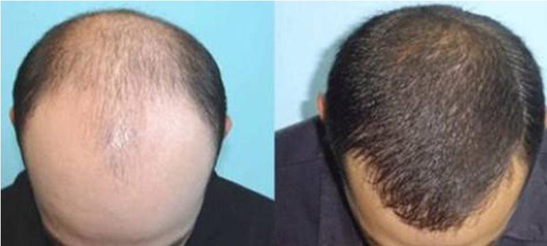 植发补发需要多少钱？手术大概操作流程