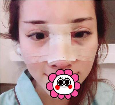 杨群申医生做鼻子手术术后
