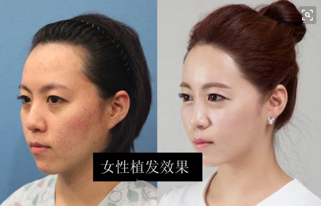 植发的价钱大概多少？按什么收费的？