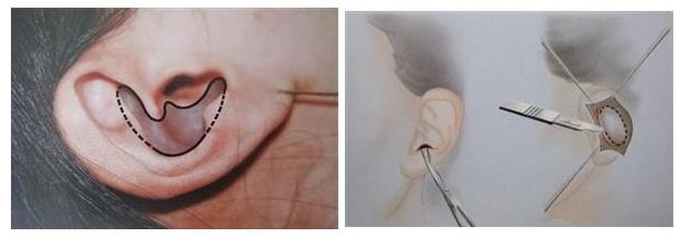 在做了耳软骨垫鼻梁以后，耳软骨是否会被吸收？