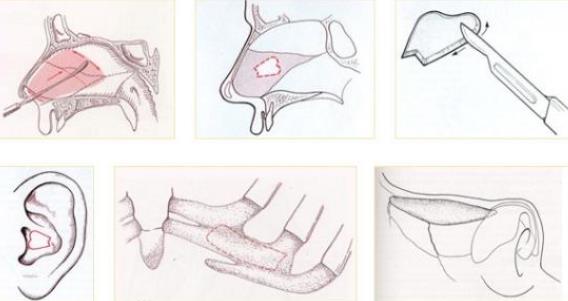 自体耳软骨隆鼻手术的注意事项