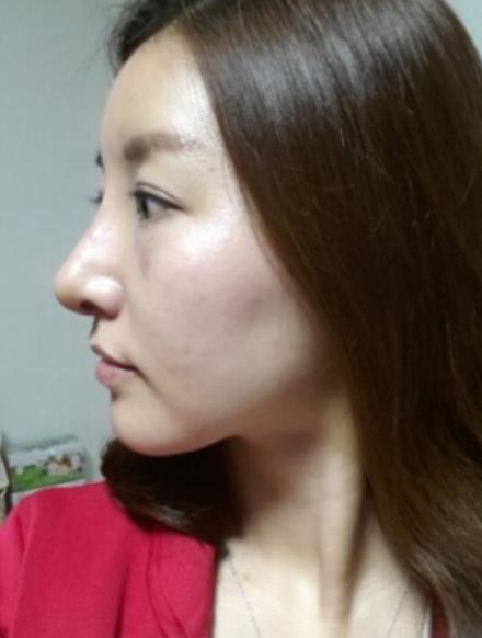 驼峰鼻矫正手术术后一个月
