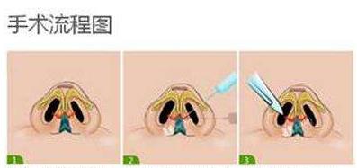 蒜头鼻矫正手术