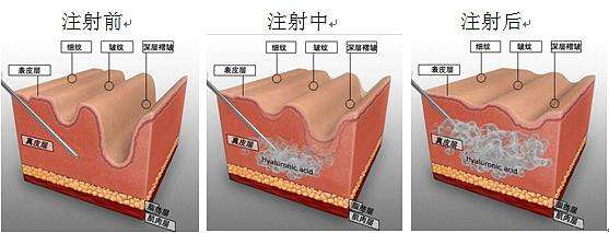 郑州注射瑞蓝玻尿酸多少钱？哪家医院正规？