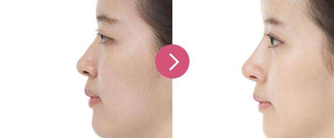 鼻头鼻翼鼻尖整形恢复时期做好这几招能恢复较快