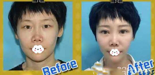 天津薇什医疗美容诊所双眼皮手术一例