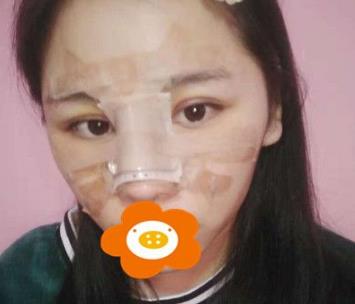 杭州薇琳自体隆鼻手术介绍：美鼻速成记