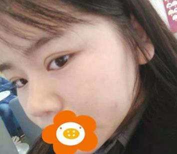 杭州薇琳自体隆鼻手术案例图：美鼻速成记